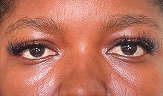under-eye hollows